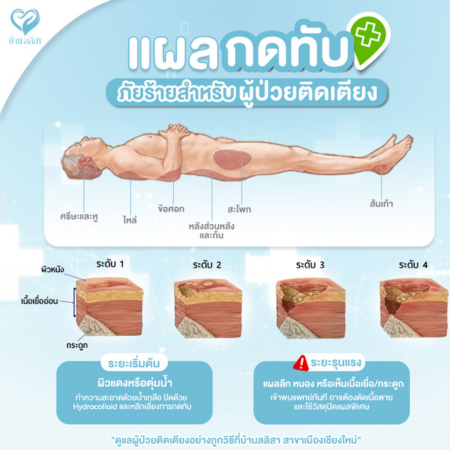 แผลกดทับ ภัยร้ายสำหรับผู้ป่วยติดเตียง